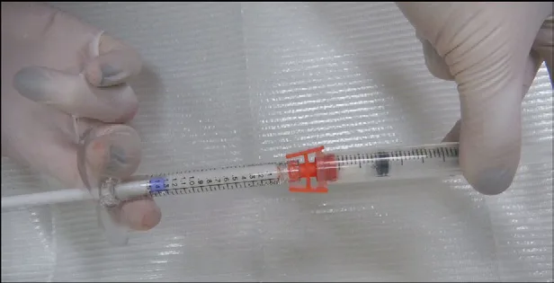Fig 6. Mezcla de hidroxiapatita cálcica con lidocaína mediante conector luer hembra-hembra.